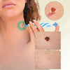 DermaLinx Wart Remover | Painless Removal of Warts and Moles | For Home Use | No Surgery