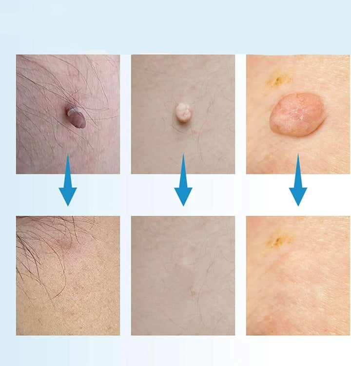 Dermaswift – Remove Skin Blemishes Against Warts and Skin Growths