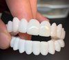 DentAlign Dental Veneers – Natural Fit and Comfort
