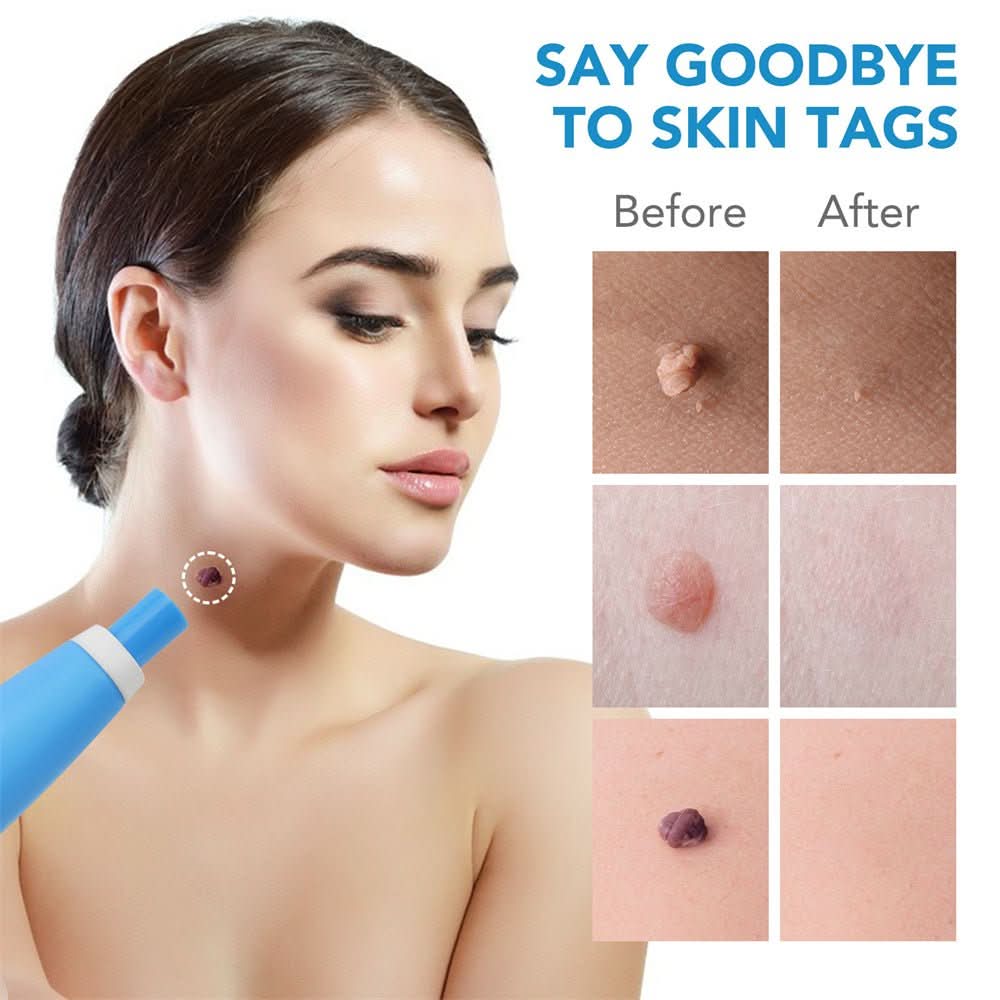 Dermaswift – Remove Skin Blemishes Against Warts and Skin Growths