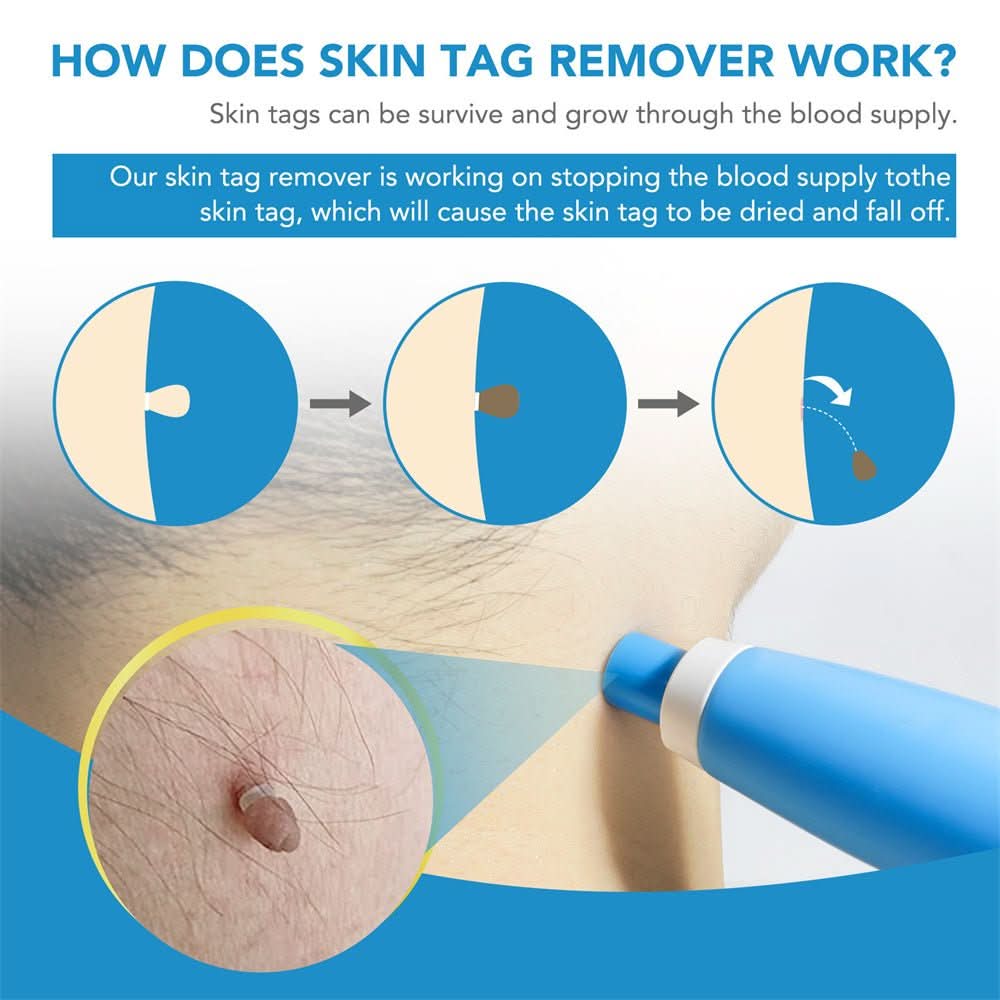 Dermaswift – Remove Skin Blemishes Against Warts and Skin Growths