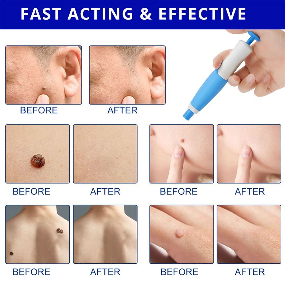 Dermaswift – Remove Skin Blemishes Against Warts and Skin Growths