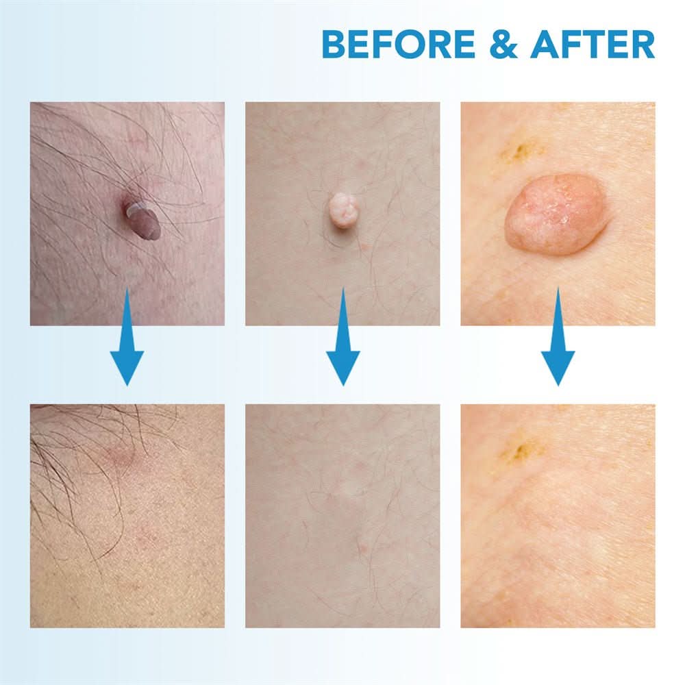 Dermaswift – Remove Skin Blemishes Against Warts and Skin Growths
