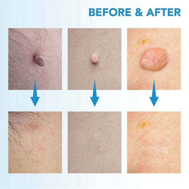 Dermaswift – Remove Skin Blemishes Against Warts and Skin Growths